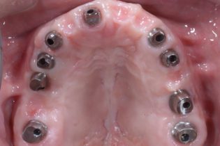 奥歯のインプラントほぼ全てに感染が生じて骨が溶けてしまている