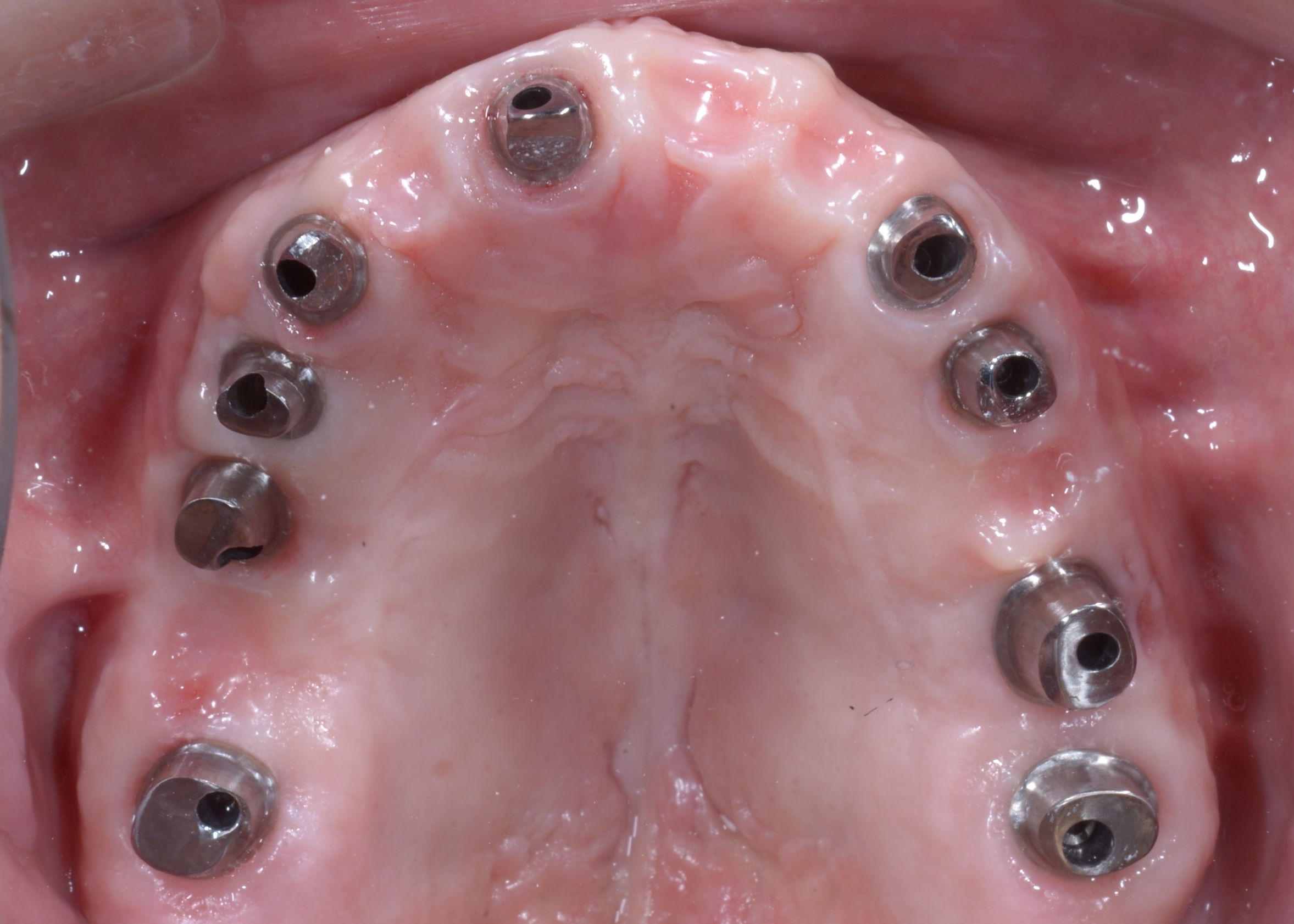 奥歯のインプラントほぼ全てに感染が生じて骨が溶けてしまている
