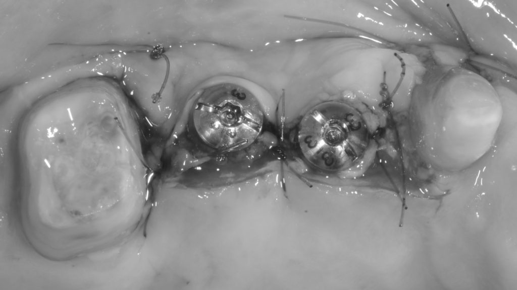 インプラント２次手術、角化歯肉移植
