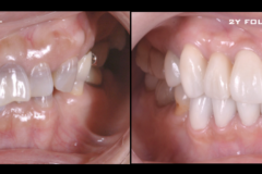 変色歯と噛み合わせの治療