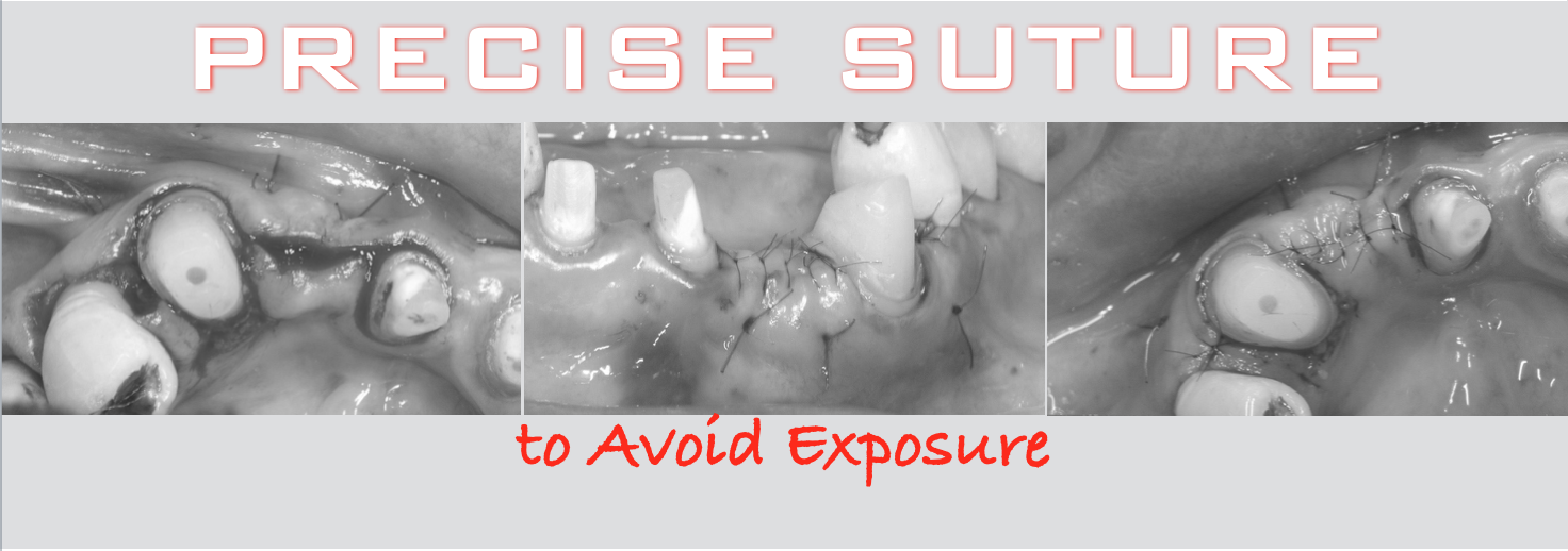 治療期間５年半、当院チーム治療によってまたお一人安定した噛み合わせを回復されました！！