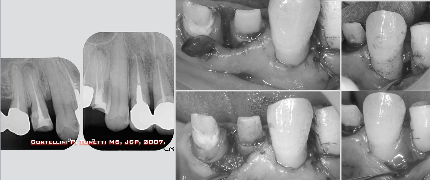 治療期間５年半、当院チーム治療によってまたお一人安定した噛み合わせを回復されました！！