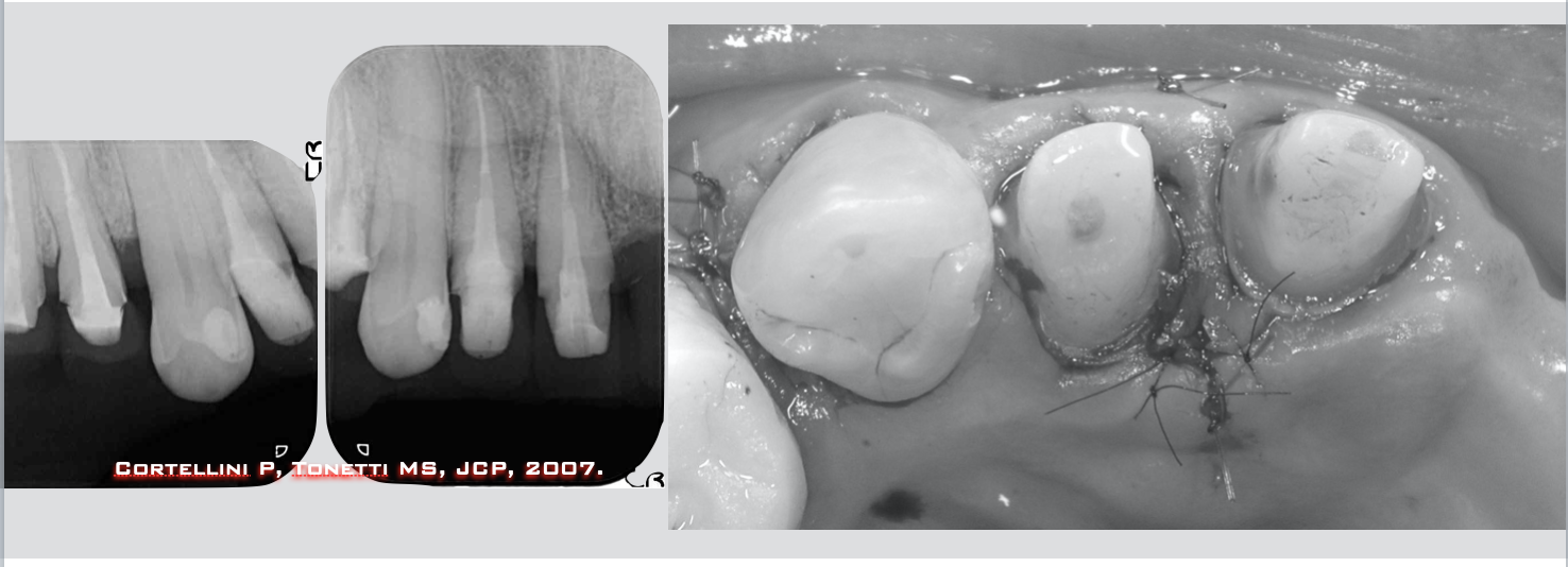 治療期間５年半、当院チーム治療によってまたお一人安定した噛み合わせを回復されました！！