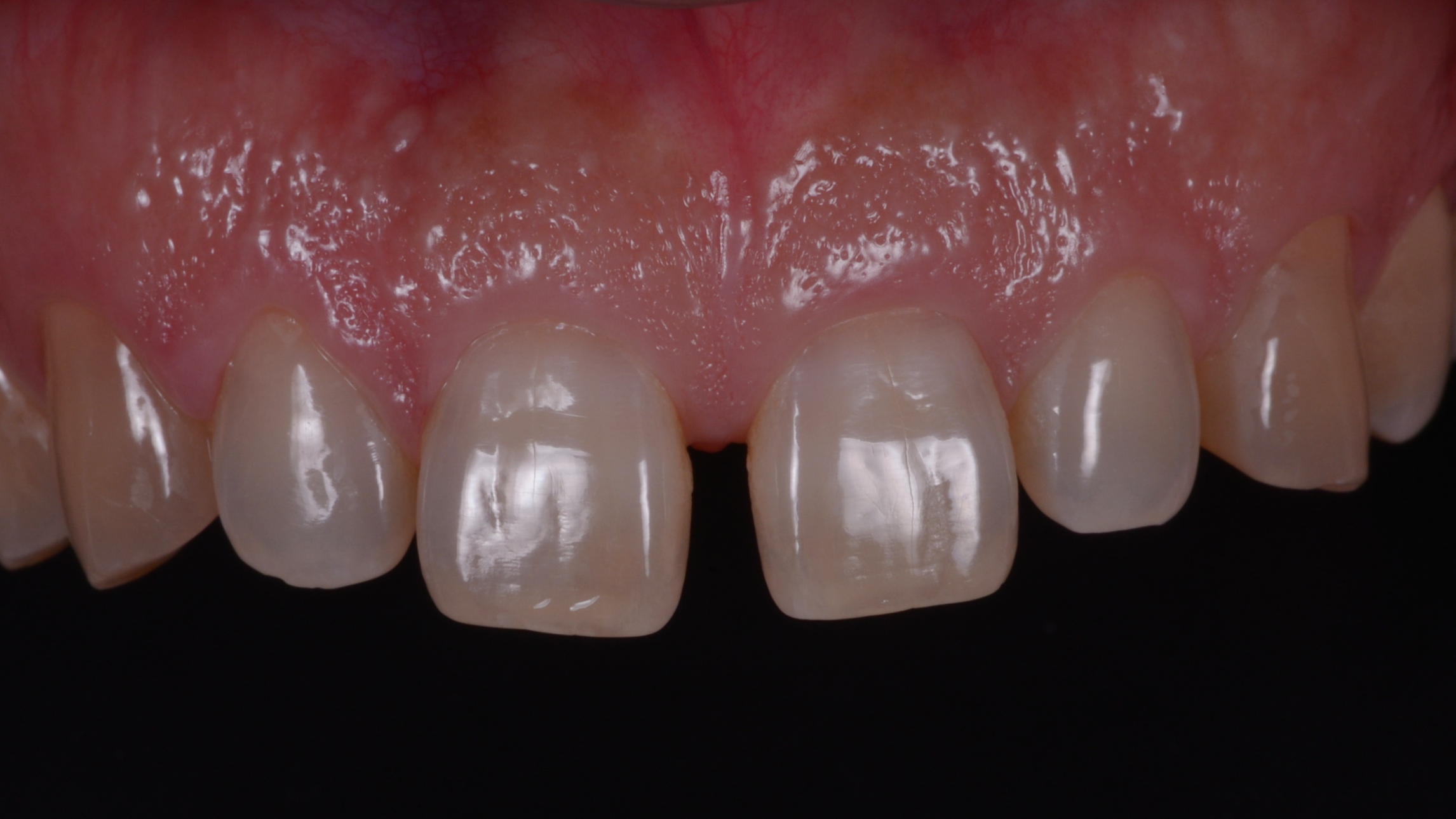 前歯がすきっ歯