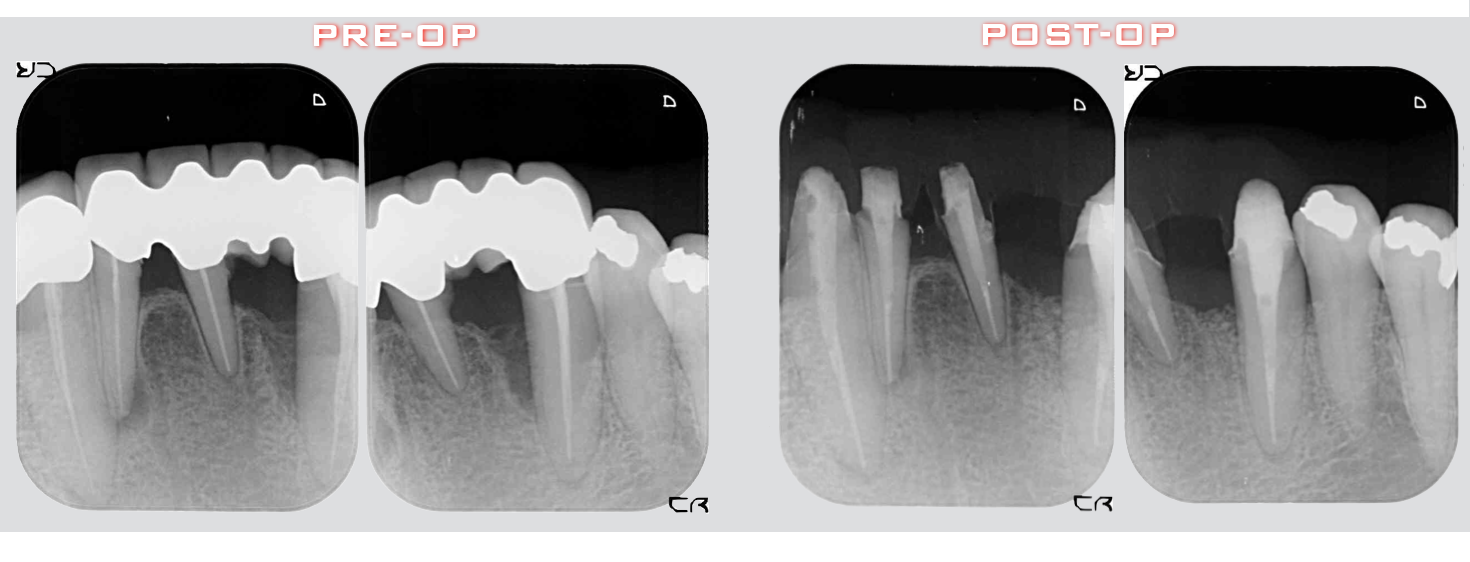 治療期間５年半、当院チーム治療によってまたお一人安定した噛み合わせを回復されました！！