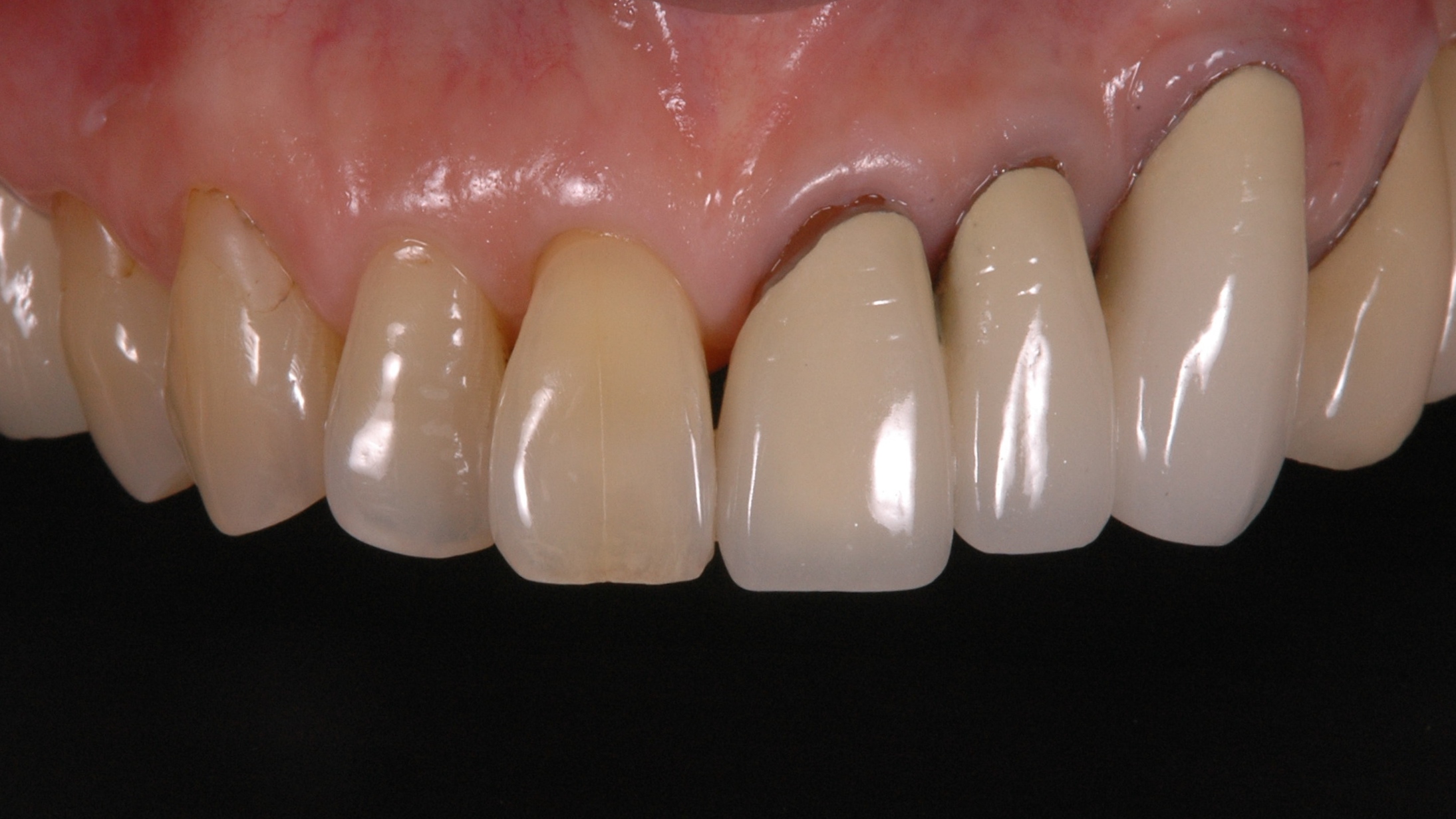 向かって右側の前歯が長過ぎる