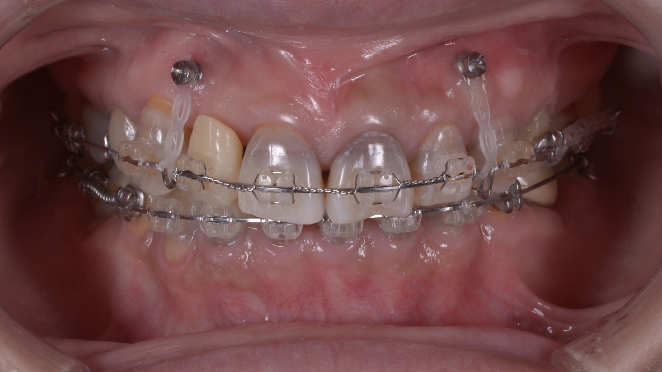 歯並びも変色した歯も気になる、どうしたら治りますか？