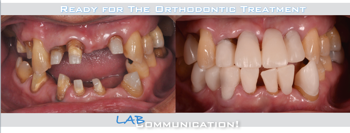 治療期間５年半、当院チーム治療によってまたお一人安定した噛み合わせを回復されました！！