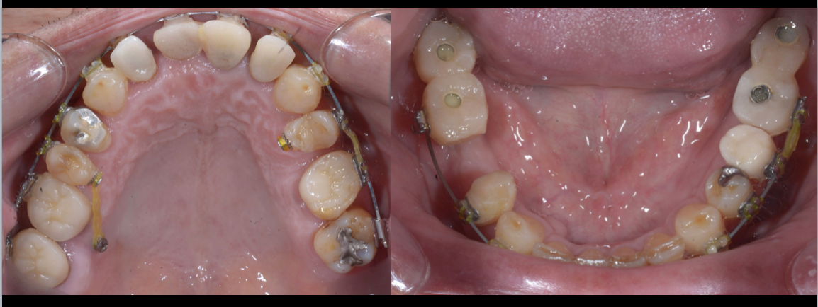 総治療期間５年、矯正治療、インプラント治療、補綴治療による全顎咬合再構成！