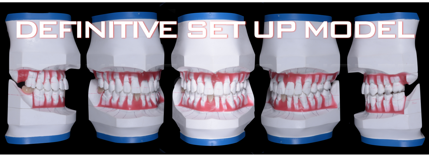 治療期間５年半、当院チーム治療によってまたお一人安定した噛み合わせを回復されました！！