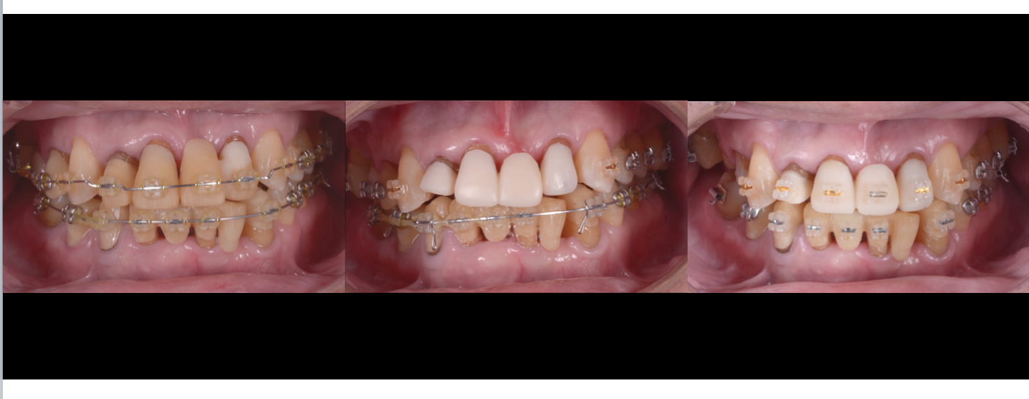 治療期間５年半、当院チーム治療によってまたお一人安定した噛み合わせを回復されました！！