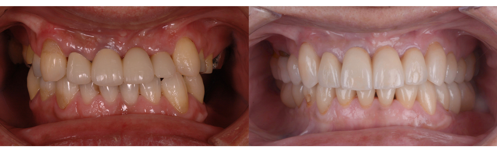 総治療期間５年、矯正治療、インプラント治療、補綴治療による全顎咬合再構成！