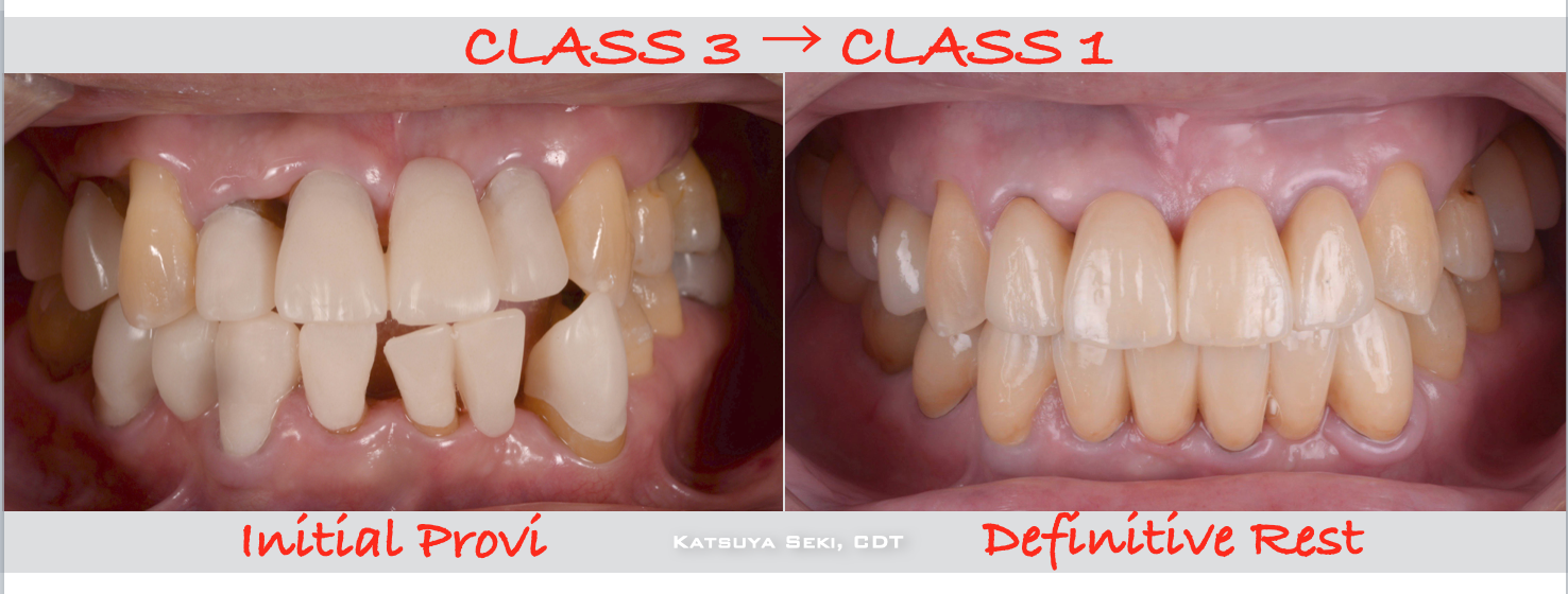 治療期間５年半、当院チーム治療によってまたお一人安定した噛み合わせを回復されました！！