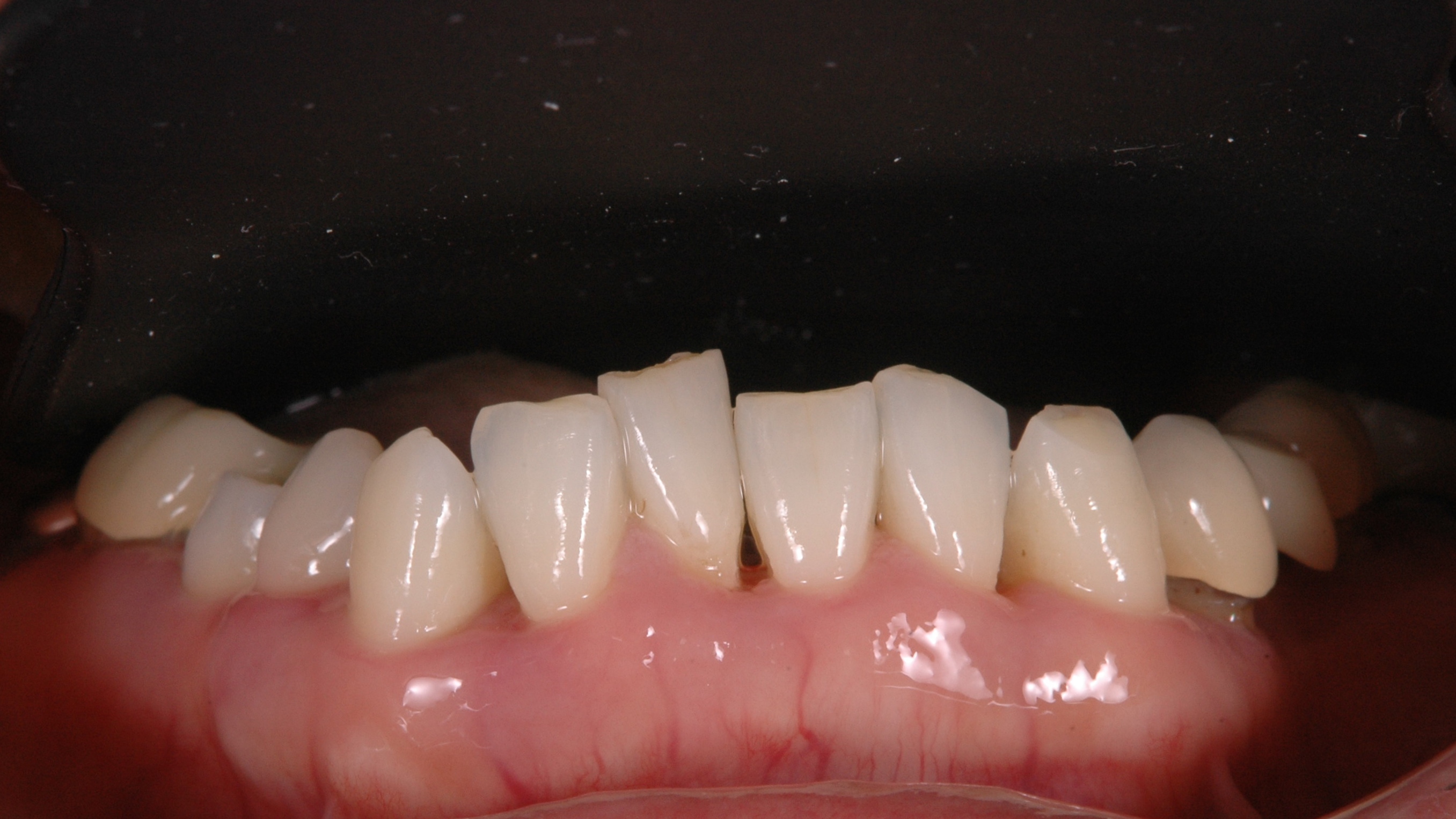 歯並び、噛み合わせが悪く歯周病になってしまっている。。。