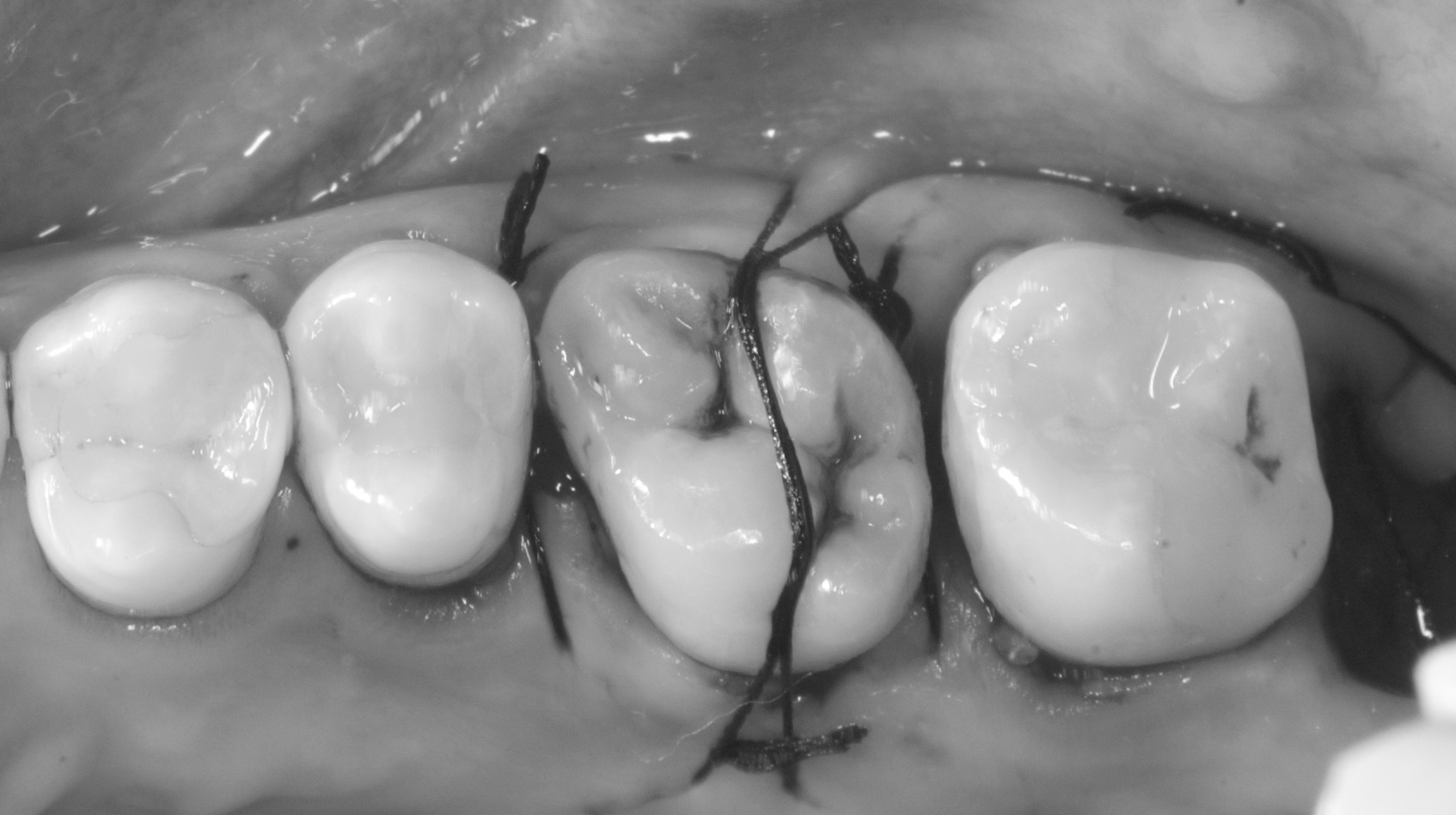 親知らず移植直後