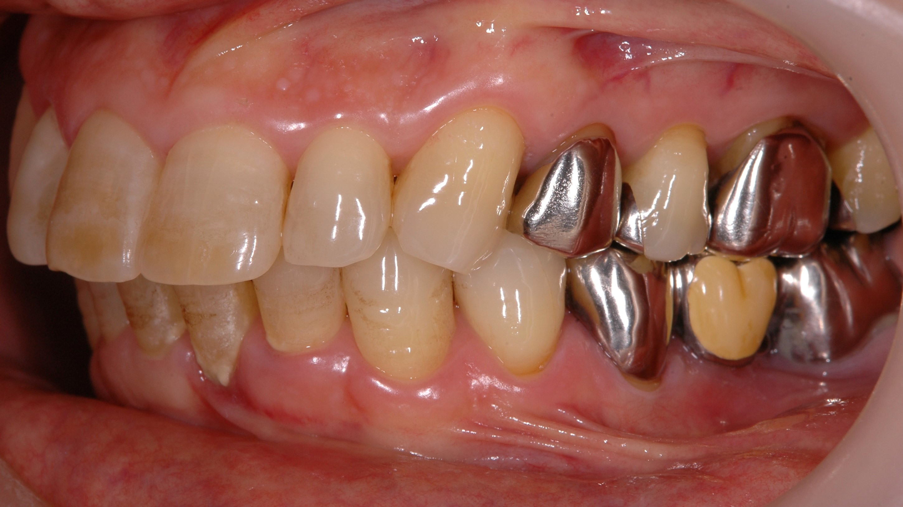奥歯が悪い方、無い方必見、奥歯の歯周病治療