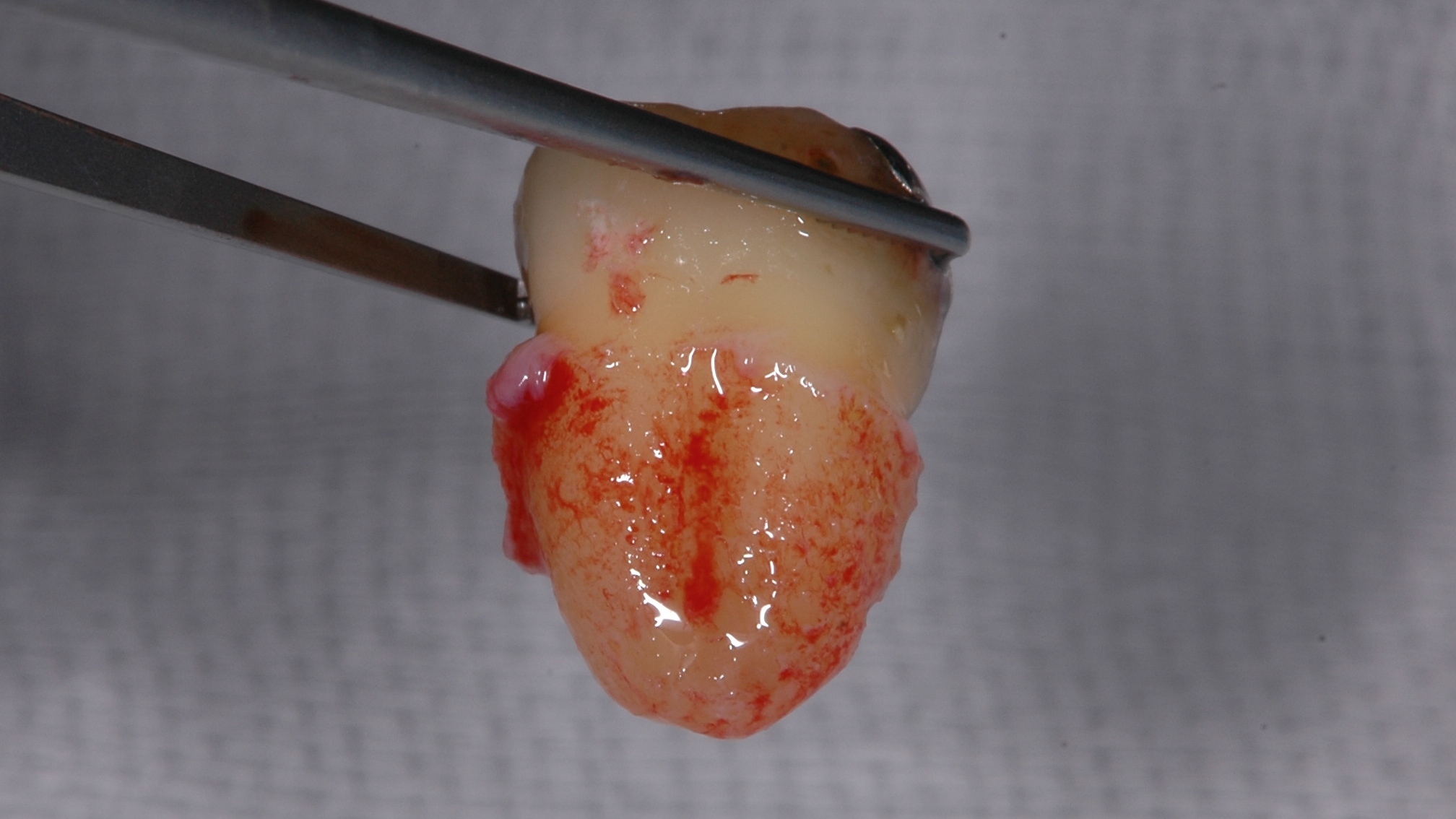 歯根膜がほぼ完璧に残っている親知らず