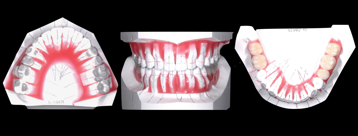 総治療期間５年、矯正治療、インプラント治療、補綴治療による全顎咬合再構成！