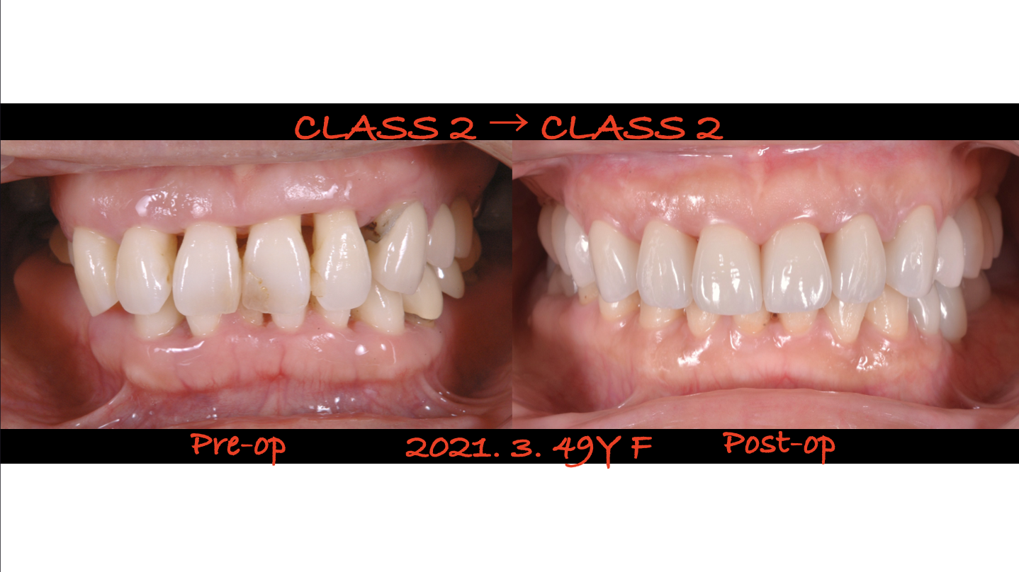 グラグラな歯、進行した歯周病、抜かずに治せる？最終章